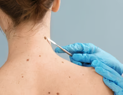 Skin Tag Treatment1