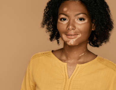 Vitiligo treatment